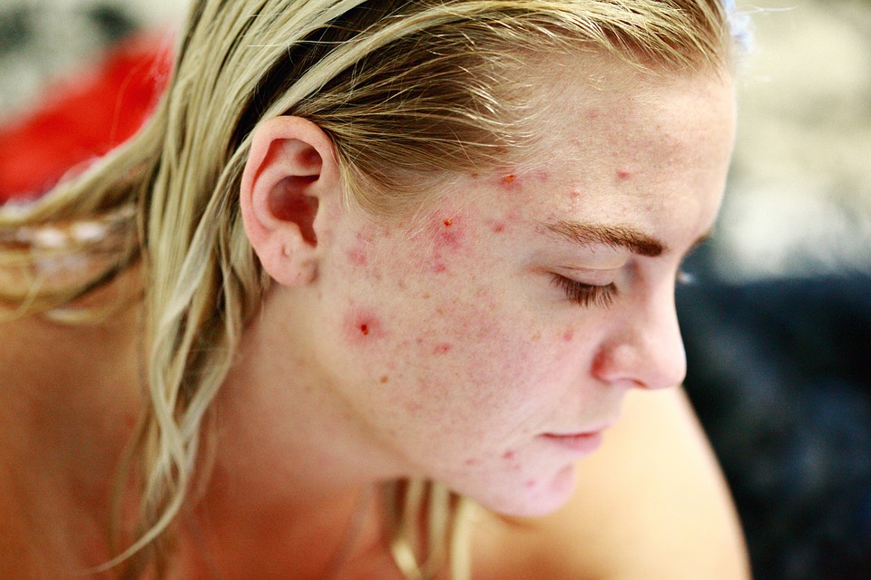 Czym się powinny charakteryzować kosmetyki do atopowej skóry